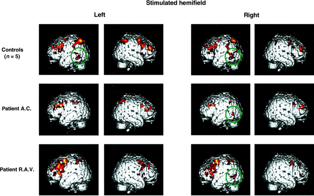 Left and Right Views of Brain Activity to Stimuli